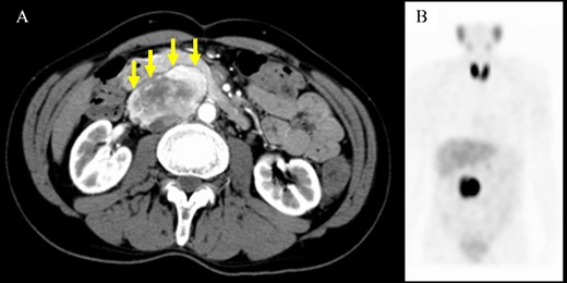 Computed tomography scan and metaiodobenzylguanidine scintigraphy. (A) Imaging findings showing a well-defined mass with heterogeneous enhancement located adjacent to the pancreatic head. A fat plane was identified between the mass and pancreas (arrows). (B) Metaiodobenzylguanidine scintigraphy revealed accumulation at the same site of the abdominal tumor.