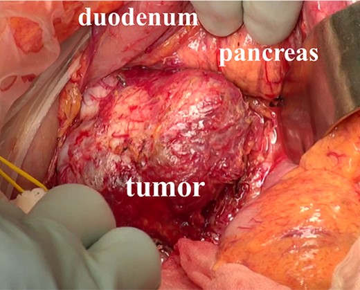 Intraoperative findings. The tumor was located behind the pancreas and the duodenum, and the mass was easy to separate from the surrounding organs.