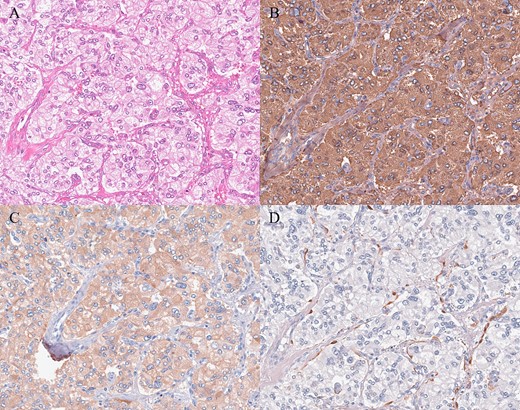Histopathologic and immunohistochemical findings. (A) Hematoxylin and eosin staining revealed tumor cells with round nuclei and eosinophilic cytoplasm arranged in a typical zellballen pattern (200×). (B, C) Immunohistochemistry showed positive staining (B chromogranin, 200×; C synaptophysin, 200×). (D) Immunohistochemical staining for S-100 revealed the presence of sustentacular spindle cells (200×).