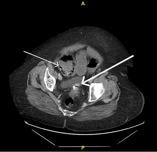 Pneumatosis intestinalis of the right colon (thin arrow) and sigmoid mass (thick arrow).
