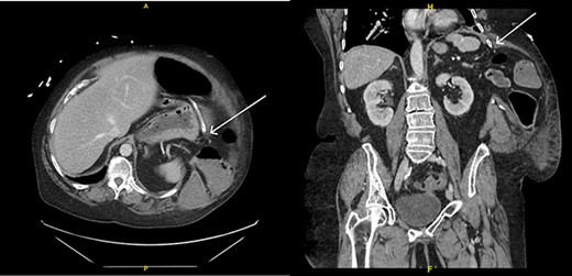 Left intercostal hernia containing loops of large bowel, axial view (left), coronal view (right).