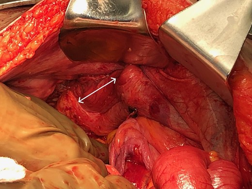 Part of the thoracic defect as seen intraoperatively (arrows).