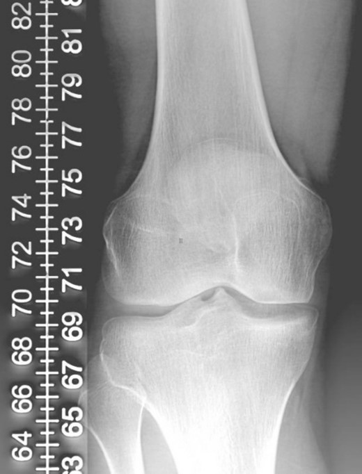 Preoperative plain radiograph of right knee showing no HO.