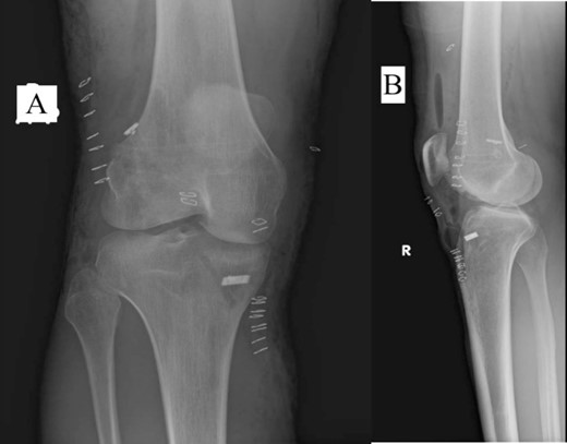 Plain radiograph of right knee AP (A) and lateral (B) 2 weeks postoperative showing no HO.