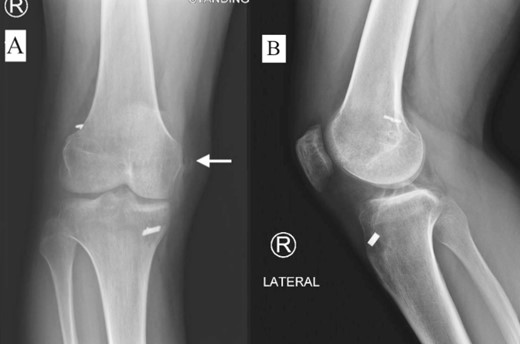 Plain radiograph of right knee AP (A) and lateral (B) 5 months postoperative showing initial HO.