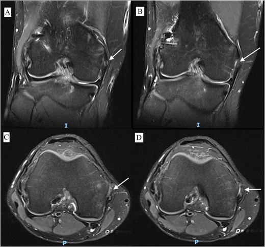 MRI T2 weighted image of right knee with different sections of coronal view (A, B) and axial view (C, D) 7 months postoperative showing HO.