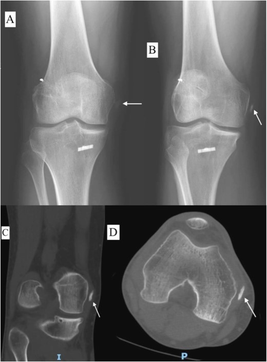 Plain radiograph of right knee AP (A), internal rotation AP (B), CT scan coronal view (C), and axial view (D) 9 months postoperative showing fully mature HO.