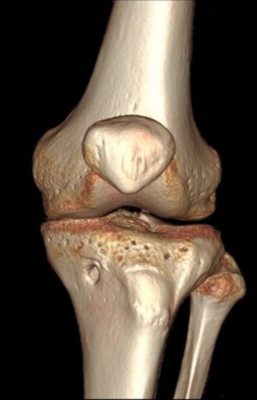 3D CT scan of left knee 2 years postoperative showing no HO.