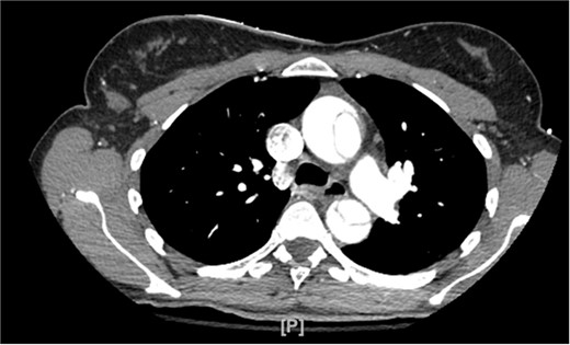 CTA demonstrating type A aortic dissection, with false lumen present in both the ascending and descending portions of the aorta.