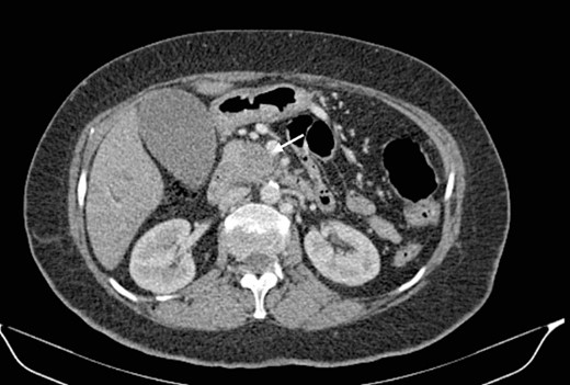 Low-enhancing poorly defined mass in the pancreatic head with surrounding fat stranding (arrow).