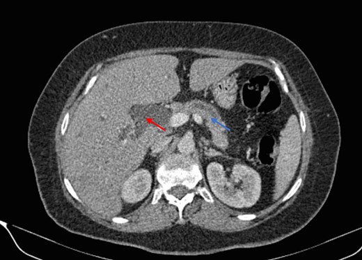 Parenchymal atrophic changes and main pancreatic duct dilatation distal to the mass (blue arrow). Extra and intrahepatic bile ducts are dilated (red arrow).