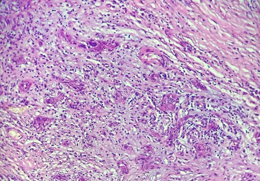 HE section: The tumor cells are so poorly differentiated that it is difficult to tell what the cell of origin is. The cells are discohesive with bizarre looking nuclei (×400).