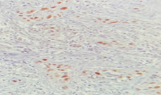 IHC: Diffuse nuclear staining of p40 by tumor cells (×400).