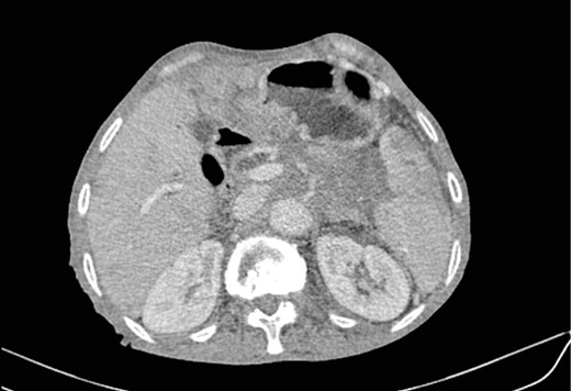 Low enhancing mass at pancreatic body and tail with internal necrotic changes. The mass encases the AMS and its branches and encases splenic vessels. Loss of the fat plane between the mass and adjacent spleen.