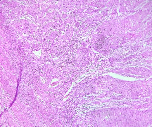 HE section showing nests and sheets of polygonal cells surrounded by fibrotic desmoplastic stroma (x100).