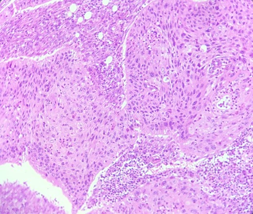 HE section: Neoplastic cells have densely chromatic enlarged nuclei with prominent nucleoli. They are enlarged with abundant eosinophilic cytoplasm and focal keratinization. Intercellular bridges are slightly visible (x200).