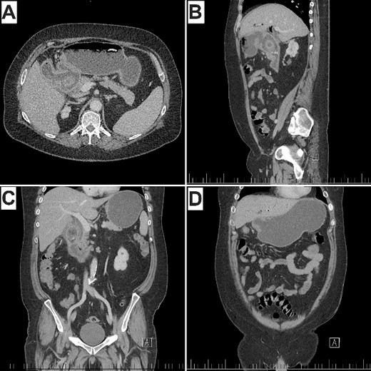CT of the abdomen and pelvis (A) axial, demonstrating pneumobilia, cholecystoduodenal fistula, and impacted gallstone. (B) Sagittal, (C) coronal, demonstrating obstructing gallstone in the proximal duodenum with distal duodenal collapse and pericholecystic inflammatory stranding. (D) Gastric distension proximal to the impacted stone. Note Rigler’s triad of pneumobilia (A), ectopic gallstone (A, B, C), and gastric outlet obstruction (B, D).