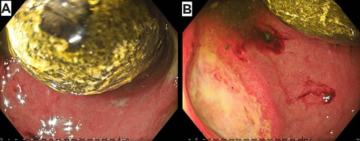 Initial gastroscopy showing impacted gallstone between the first and second parts of the duodenum (A) and the cholecystoduodenal fistula (B).