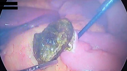 Successful laparoscopic enterolithotomy via longitudinal incision in the jejunum.