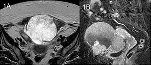 MRI T2 axial (A) and sagittal (B): solitary mass in contact with rectus abdominis.