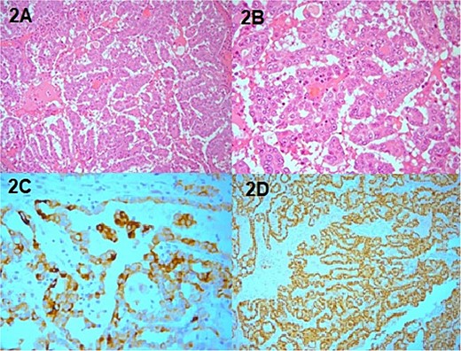 Pathology specimen, (A) H&E X20 papillary RCC, (B) H&E 40 papillary RCC, (C) PAX positive, (D) AMACR positive.