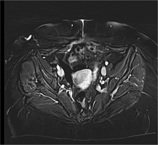 MRI T1 axial 3 months postoperative with no residual mass detected.
