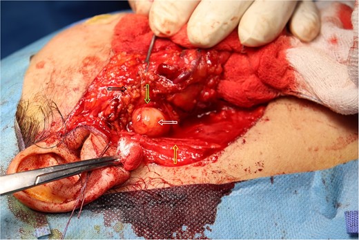 Intra-operative picture of the mass over the main trunk of the facial nerve. The white arrow indicates the mass over the main trunk of the facial nerve. The yellow arrow points to the great auricular nerve. The green arrow highlights a branch of the facial nerve. The black arrow shows the parotid gland.