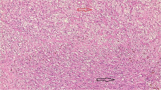 Bland-looking cellular spindle cells (dark arrow) infiltrating into adjacent fibrofatty tissue (yellow arrow), Hematoxylin, and Eosin stain. Microscopic power 4 × 10.