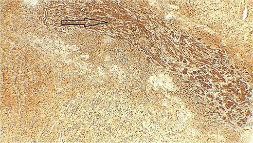 Immune stain S100, strong nuclear and cytoplasmic staining pattern in the tumor cells.