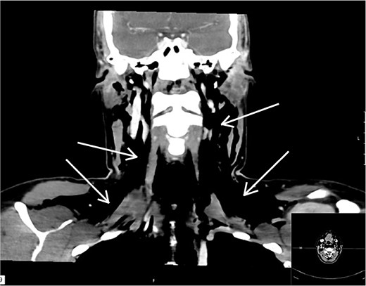 Frontal CT images of the collum. Arrows showing air pockets.