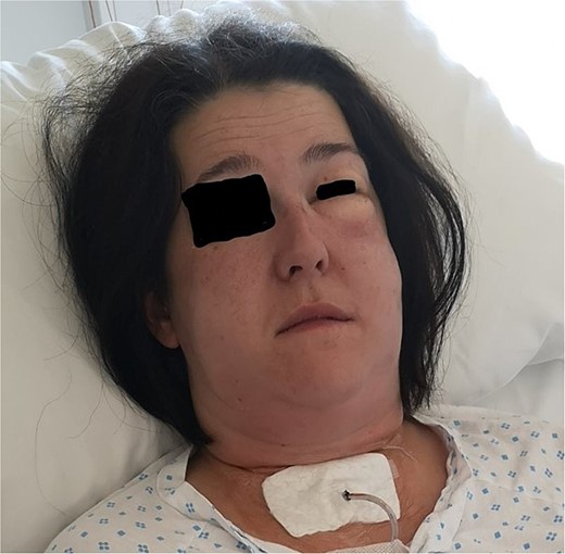 Patient with drain placed in the wound cavity and excessive emphysema on the left side. Photo: Lars Helge Kristensen.