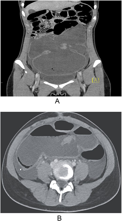 (A and B) Computerized tomography of the abdomen and pelvis with intravenous contrast showing dilated bowel with pneumatosis mimicking toxic megacolon.