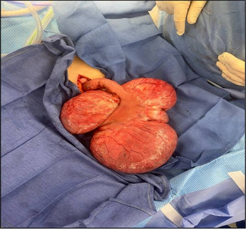 Jejunal diverticula with four saccular outpouchings.