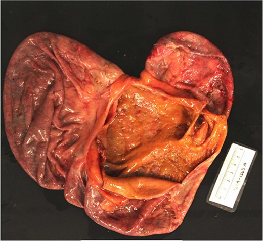 Gross tissue examination of the resected jejunal diverticula.