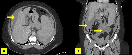 A contrast enhanced CT of abdomen and pelvis (portal venous phase) with axial (A) and coronal (B) views performed on admission demonstrating haemoperitoneum (arrows) and subcapsular spleen haematoma (asterisk).