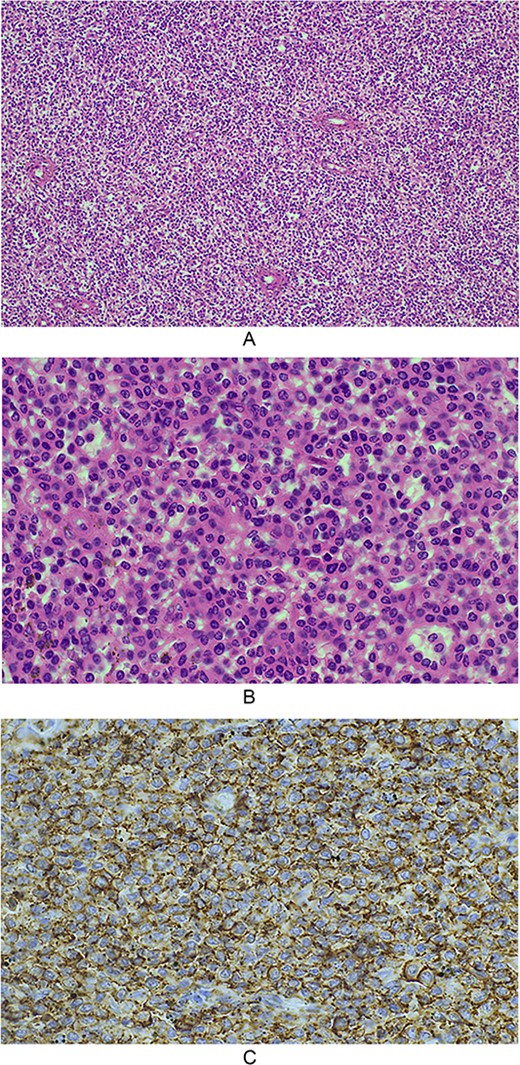 (A) 10× magnification, splenic architecture is effaced by a diffuse infiltrate of homogenous cells, which are expanding the red pulp cords and involving sinuses, with minimal white pulp seen; (B) 40× magnification, the infiltrative cells have ovoid to reniform nuclei with abundant pale eosinophilic cytoplasm. Mitotic activity is not readily identified; (C) microscopic photograph at 40× magnification demonstrates the lesional cells showing strong diffuse positive expression of CD20.