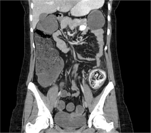 Computed tomography imaging revealed a mechanical bowel obstruction at the distal descending colon secondary to impacted fecal matter with noted colonic wall thickening and edema.