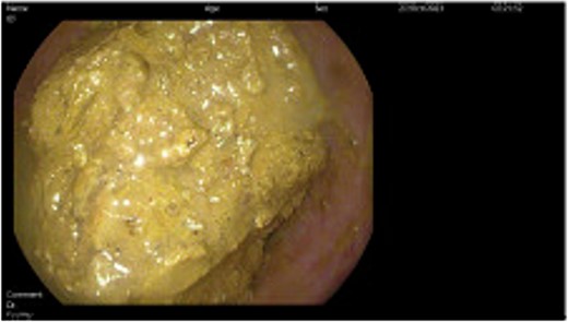 Direct visualization of the fecaloma causing colonic obstruction was obtained during the endoscopic intervention performed during hospital admission.