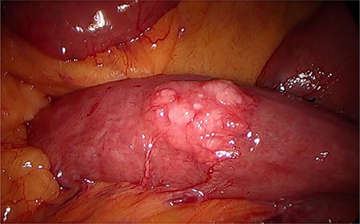 Intraoperative image during laparoscopy visualizing ectopic pancreas on serosa of the jejunum.