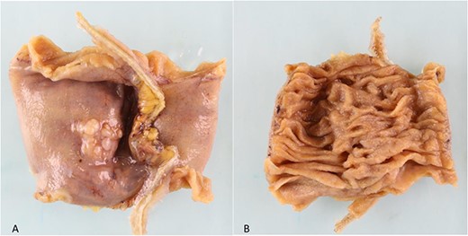 (a). Serosal surface of bowel. 16 mm white nodule noted on serosal surface. (b) Luminal surface of bowel. No abnormality seen macroscopically.