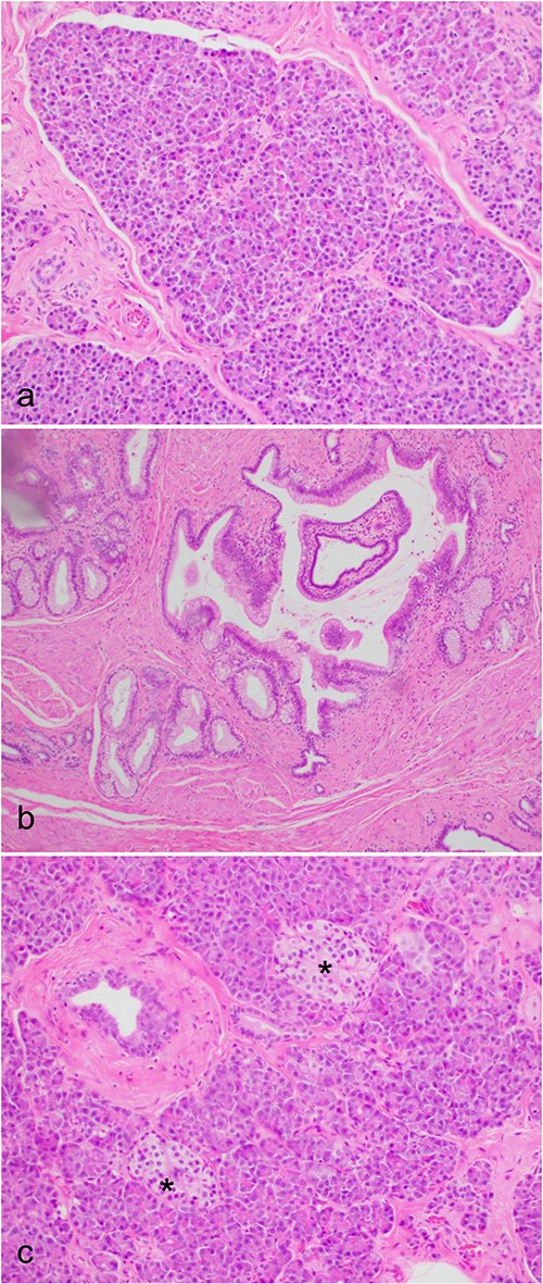 Microscopic histological images, showing (a) pancreatic acini and the exocrine pancreas within the ectopic pancreas. (b) The main pancreatic duct of the ectopic pancreas. (c) Islet’s of Langerhans (*) and the endocrine pancreas within the ectopic pancreas.