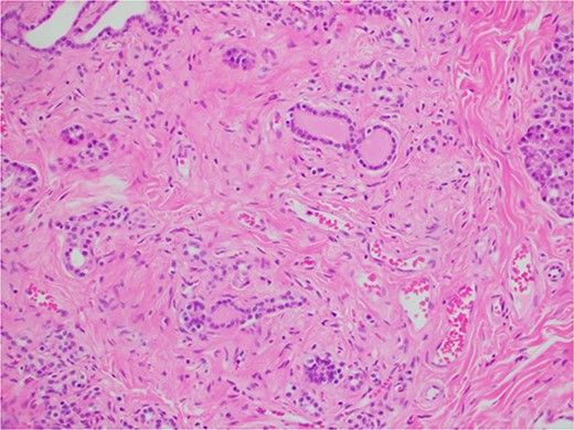 Microscopic histological image showing pancreatic atrophy and fibrosis with scattered chronic inflammation, indicative of past pancreatitis.