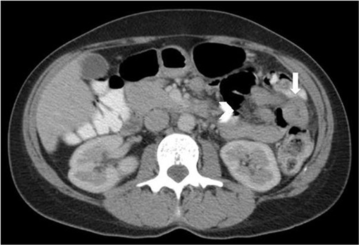 Axial CT abdomen and pelvis with portal venous phase and oral contrast, demonstrating a short segment of thickened jejunum (arrow) in the left upper quadrant with associated mesenteric enhancement (arrow head).