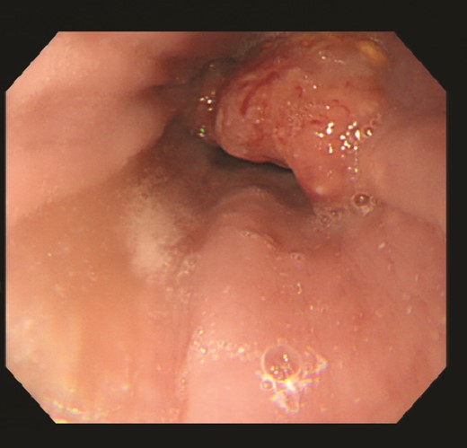 Upper gastrointestinal endoscopy revealed a type 3 esophagogastric junction tumor that had invaded the esophagus by 2 cm. Endoscopically, the neck of the tumor was located at the junction, and together with the histopathologic results, a diagnosis of Siewert type 2 esophagogastric junction carcinoma was made. Initially, a squamous cell carcinoma component and an adenocarcinoma component were observed, and the patient was suspected of having basal cell carcinoma.