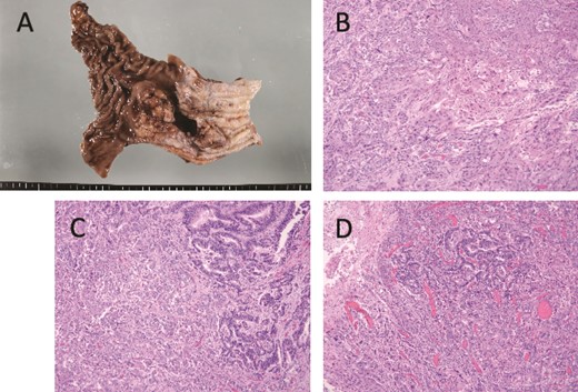 Macroscopic and microscopic findings. (A) Macroscopic findings of the resected specimen. A type 3 tumor of about 5 cm with a tumor center is seen at the esophagogastric junction. (B) Histological findings, showing a squamous cell carcinoma area. The tumor was found mainly in the superficial layer of the tumor and not in the deeper layers. (C) Boundary between well-differentiated (left side) and poorly differentiated (right side) adenocarcinoma. The tumor was found to be poorly differentiated adenocarcinoma-like mainly in the middle to deep layers of the tumor center. The superficial part of the tumor was transformed into a well-differentiated adenocarcinoma. (D) The boundary area between the three cancer components is shown. The squamous cell carcinoma component and the well-differentiated adenocarcinoma component are bordered by the superficial portion and the poorly differentiated adenocarcinoma-like portion in the deeper portion, respectively.