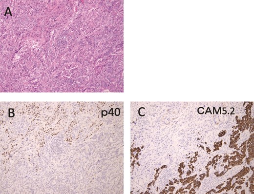 Immunohistochemical findings are shown. (A) Hematoxylin and Eosin staining specimen with histological evidence of adenocarcinoma (lower half) and squamous cell carcinoma (upper half) components. (B) The squamous cell carcinoma component showed p40-positive findings. (C) On the other hand, CAM5.2 positive findings were observed in the adenocarcinoma component.