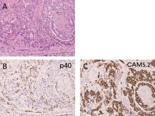 Immunohistochemical findings are shown. (A) Hematoxylin and eosin staining shows areas of moderately or poorly differentiated adenocarcinoma. (B, C) p40-positive cells were observed, mixed with CAM5.2-positive cells, and only one of them was positive.