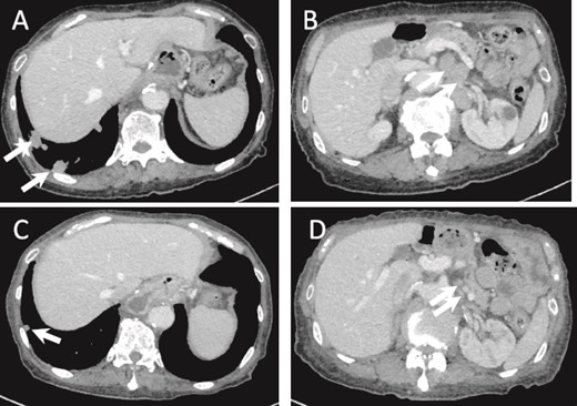 (a) CT image 5 months after surgery. Multiple lung metastases are seen (arrows). (B) Intra-abdominal lymph node metastasis is shown (arrows). (C, D) Lung and lymph node metastases after one cycle of chemotherapy show PR (arrows).