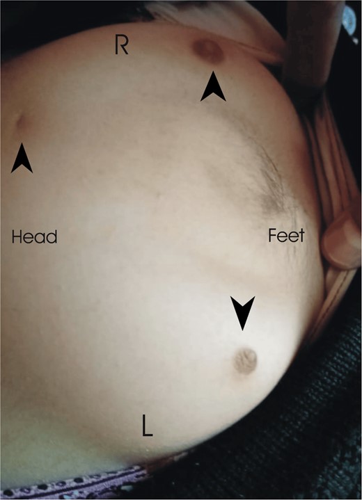 This is the dorsal spine of the patient showing bilateral ectopic breasts (R = right, L = left) and three ectopic nipples (black arrowheads).