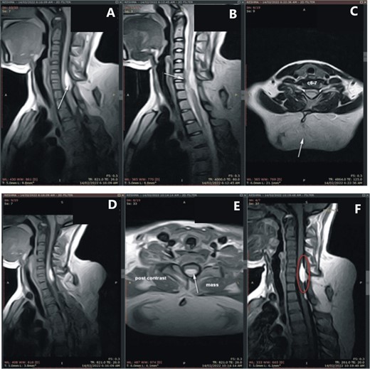 (A) MRI of the cervical and dorsal spine; (C) a large, poorly encapsulated fat signal mass in the inferior neck and superior dorsal region (white arrow), and (B, D) an intraspinal epidural extension at the C6-C7 vertebral level, protruding into the spinal canal and positioned posteriorly opposite to the C6 and C7 vertebral bodies (white arrows), and (A, F) a bony structure connecting the spinous process at the C6 vertebral body to the T3 vertebral body (white arrow and red circle).